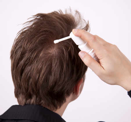 Hair Loss Treatment Fort Lauderdale | Hair Loss Solutions