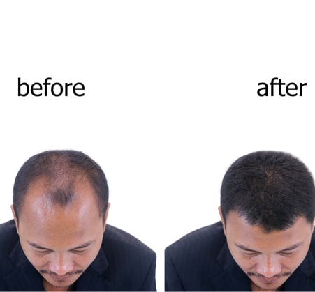 Hair Loss Treatment Fort Lauderdale | Hair Loss Solutions