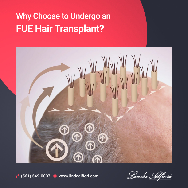 FUE Hair Transplant Boca Raton